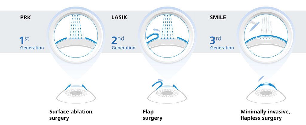 schwind-femto-ldv-lenticule-extraction-atik-kr