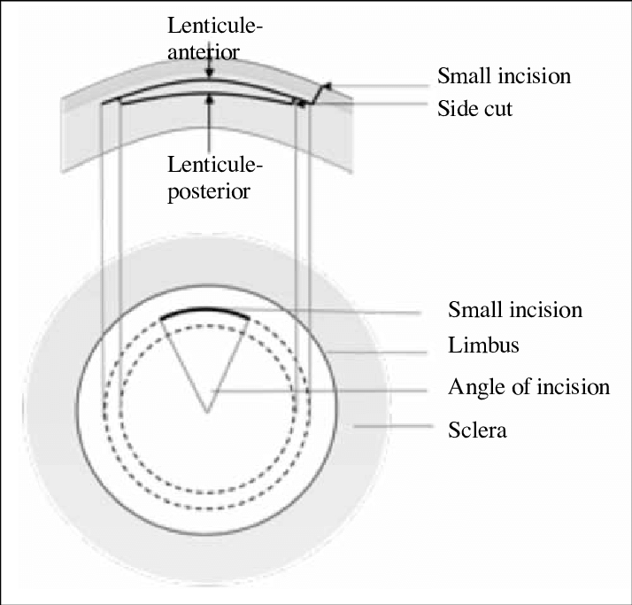 Treatment of horizontal impaction of left mandibu - 굿스마일포럼